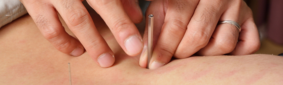 鍼灸施術